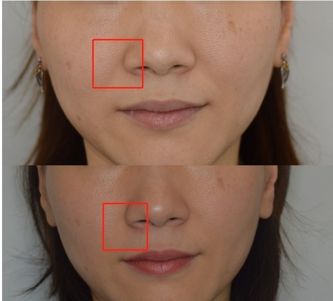 Face Fillers Before And After Pics Transformative Results Devoluxplla