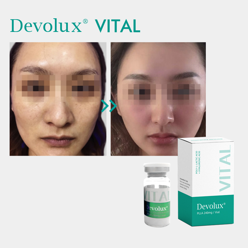 The Remarkable Transformation: PLLA Filler Before and After: Devoluxplla